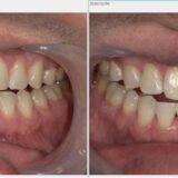 【症例紹介】オフィスホワイトニング― 31歳男性／3回施術の経過 ―