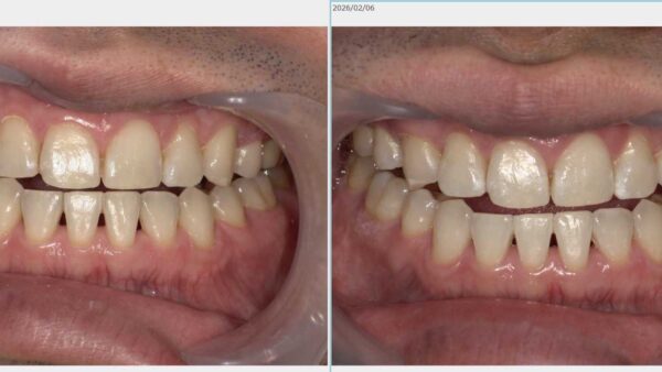 【症例紹介】オフィスホワイトニング― 31歳男性／3回施術の経過 ―