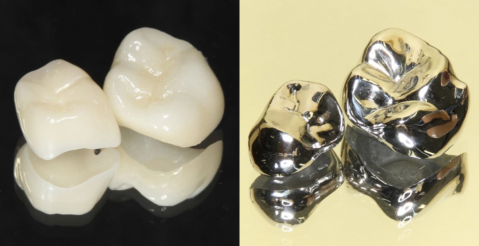 セラミックと銀歯の違いについて - 新潟市中央区の歯医者 - からさわ