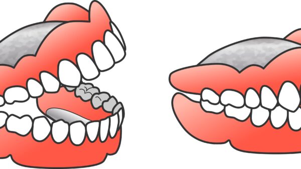 金属床義歯とは？〜薄く設計しやすい入れ歯を検討したい方へ〜